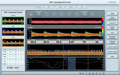 Intraoperative Neuro Monitoring with Dolphin TCD