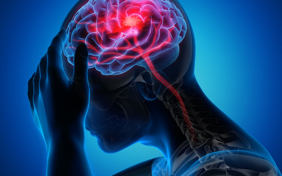 The Role of TCD in Stroke Prevention