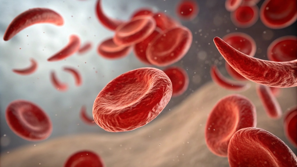 TCD for Sickle Cell Patients: Life-Saving Early Detection