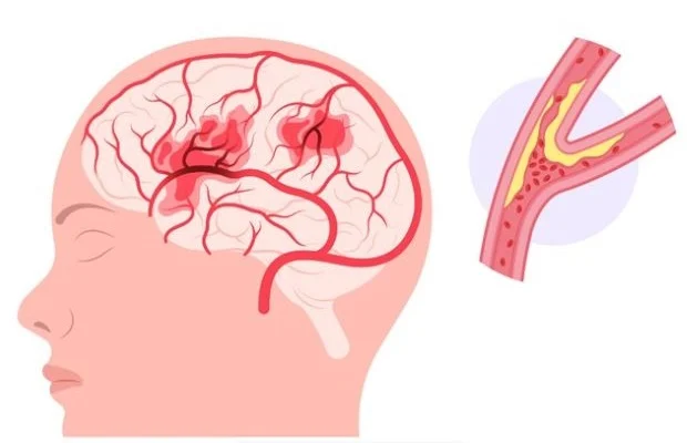 Dolphin TCD vs. Other Neurovascular Tests